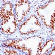 FFPE human prostate carcinoma sections stained with 100 ul anti-Androgen Receptor (clone SPM335) at 1:50. HIER epitope retrieval prior to staining was performed in 10mM Tris 1mM EDTA, pH 9.0.